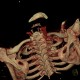 Cervical rib, compression of subclavian vein, trombosis of subclavian vein: CT - Computed tomography
